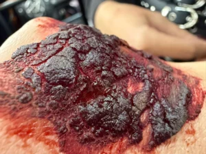 ustioni-da-calore-trucco-sfx Napoli